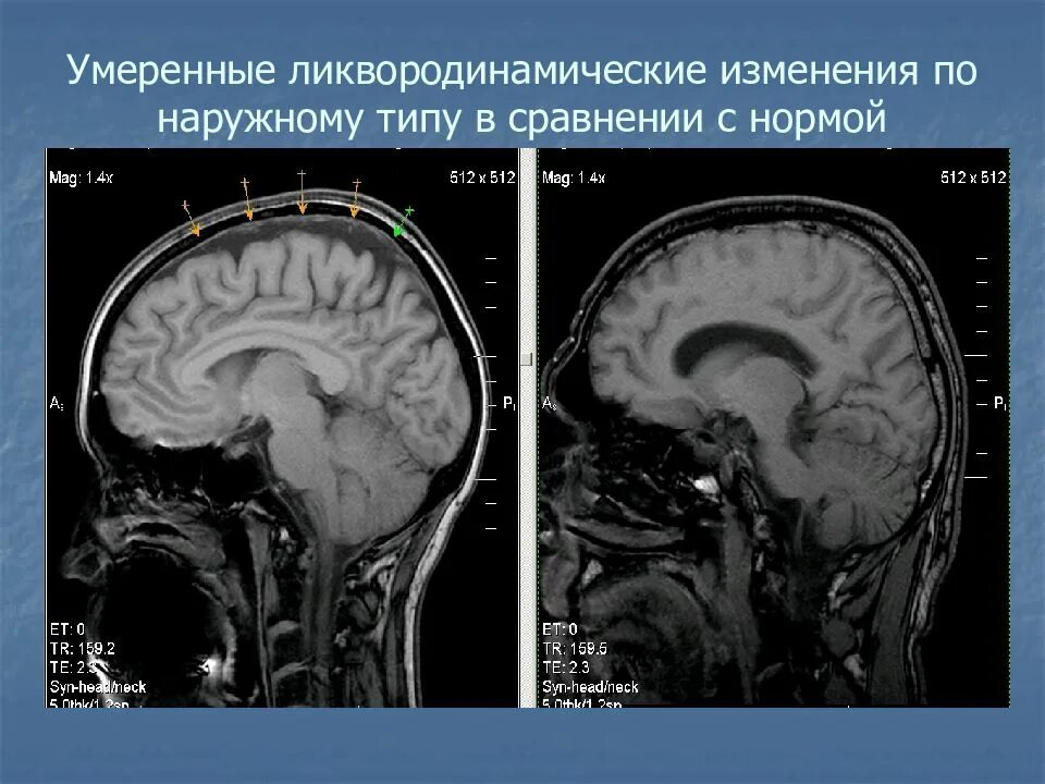 Заместительная наружная гидроцефалия кт. Гипертензивная гидроцефалия мрт. Рассеянный склероз гидроцефалия. Гидроцефалия головного мозга на кт. Ликворные изменения мозга