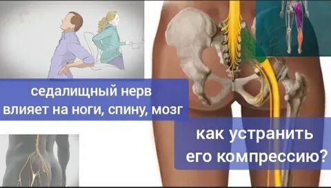 Как вылечить седалищный нерв на правой ягодице