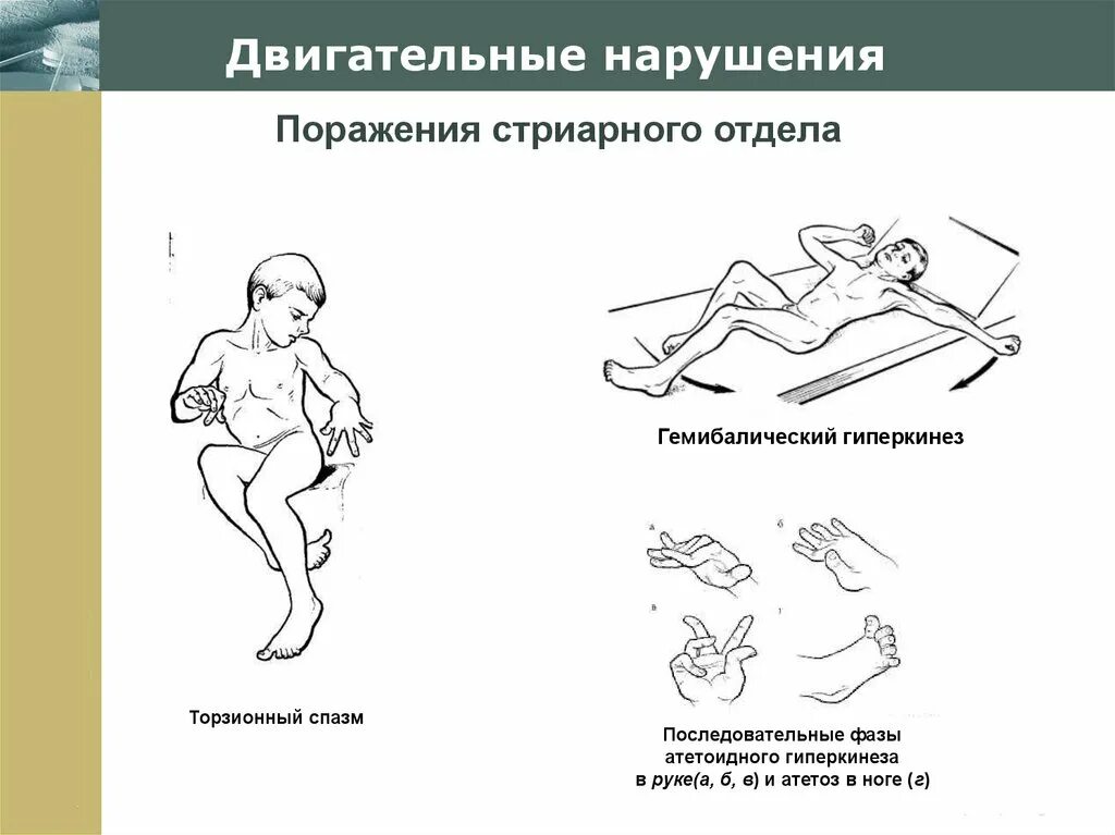 Двигательные расстройства при дцп. Двигательные нарушения. симптомы двигательных нарушений. двигательные нарушения в неврологии.