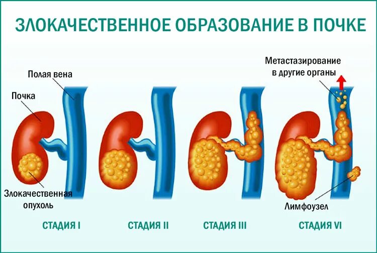 Злокачественные образования. Раково образование. Причины новообразований. Злокачественные новообразования гортани. Раково образование.