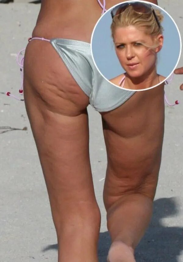 Целлюлит у худых. Липодистрофия целлюлит. Целлюлит у худых девушек. Целлюлит у худых. Риз уизерспун целлюлит.