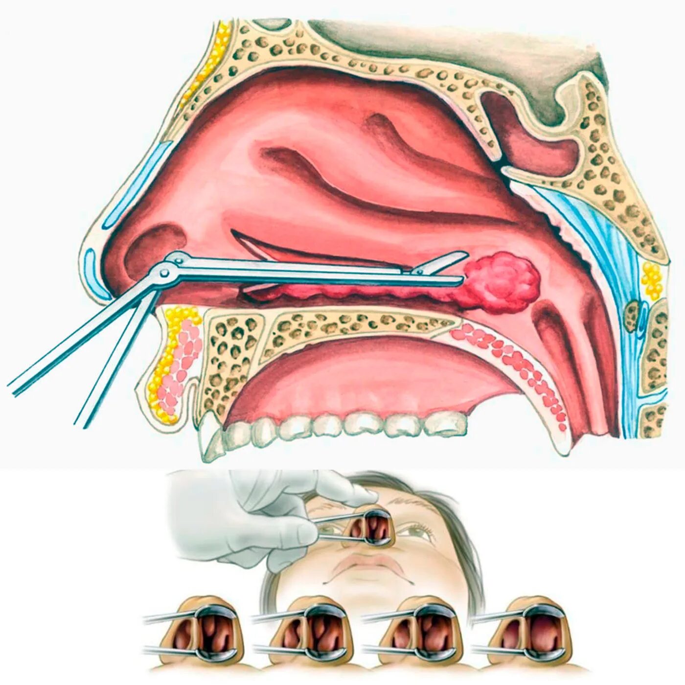 Конхотомия носовых раковин. Вазотомия носовых раковин. Конхотомия нижних носовых раковин. Эндоскопическая конхотомия. Вазотомия носовых раковин операция