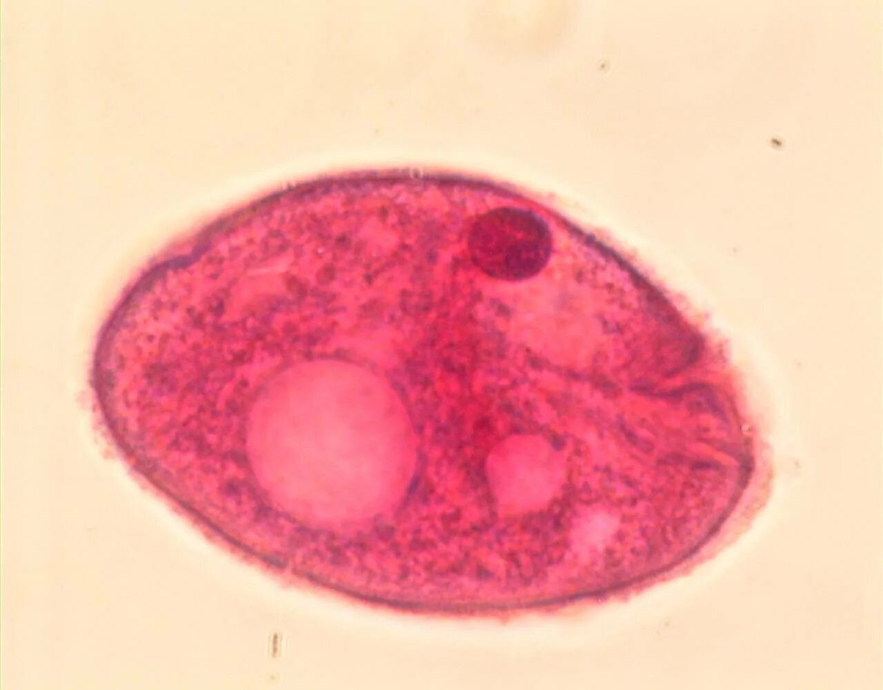 Балантидий кишечный заболевание. Балантидиаз возбудитель заболевания. Балантидиаз. Балантидиаз. Балантидий кишечный (balantidium coli).