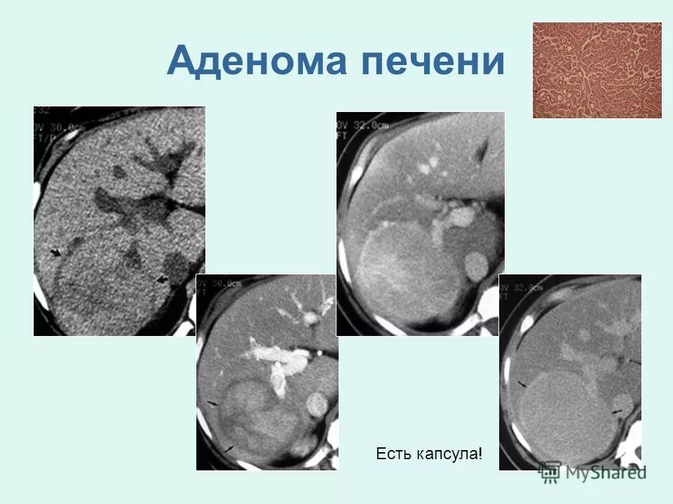 Гепатоцеллюлярная аденома печени кт. Гепатоцеллюлярная карцинома печени мрт. Гепатоцеллюлярная аденома мрт. Кт признаки аденомы печени.