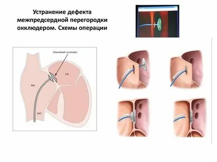 Эндоваскулярное закрытие дмпп