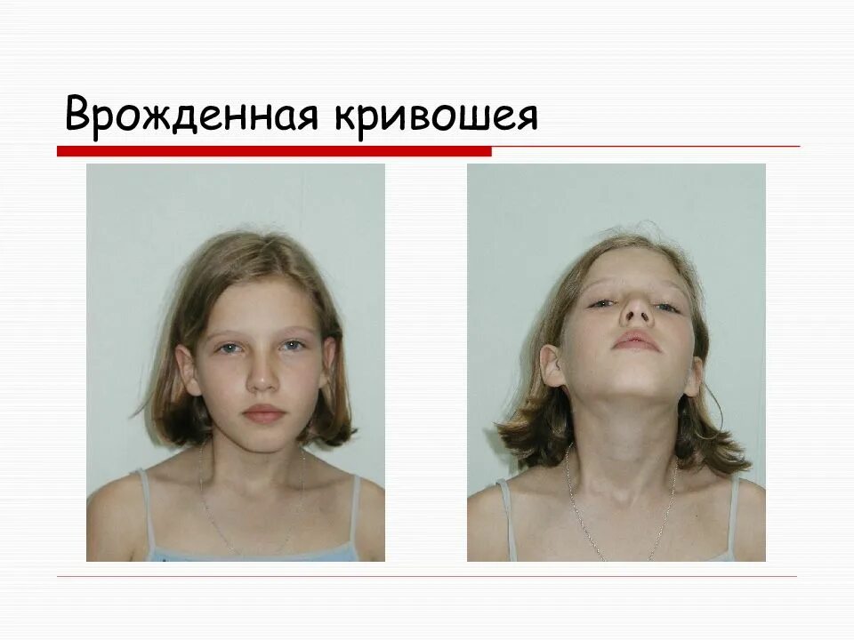 Кривошея у ребенка 2 месяца. Тетраплегия при повреждении спинного мозга. Шейный паралич. Воротник шанца для новорожденных при кривошее. Синдром поражения шейного утолщения спинного мозга.