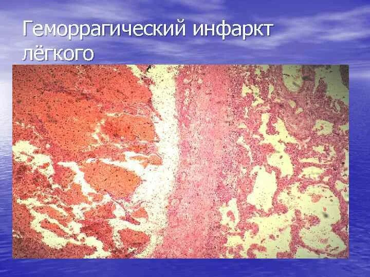 Красный инфаркт легкого микропрепарат. Геморрагический инфаркт легкого патанатомия макропрепарат. Геморрагический инфаркт лёгкого микропрепарат. Гемаррогический инфракт легкого патанат. Геморрагический инфаркт легкого.