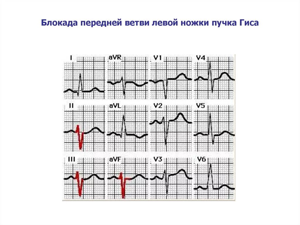 Блокада задней ножки. Блокада передней ветви левой ножки пучка Гиса на ЭКГ. Блокада ветвей левой ножки пучка Гиса на ЭКГ. Блокада передне-верхней ветви ЛНПГ. ЭКГ при блокаде передней ветви левой ножки пучка Гиса.