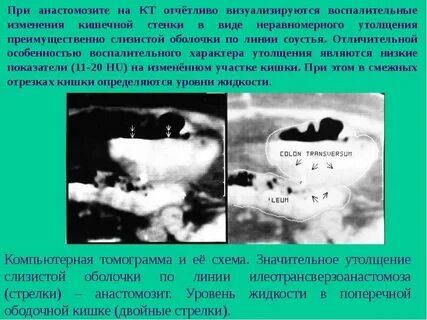 Анастомозит