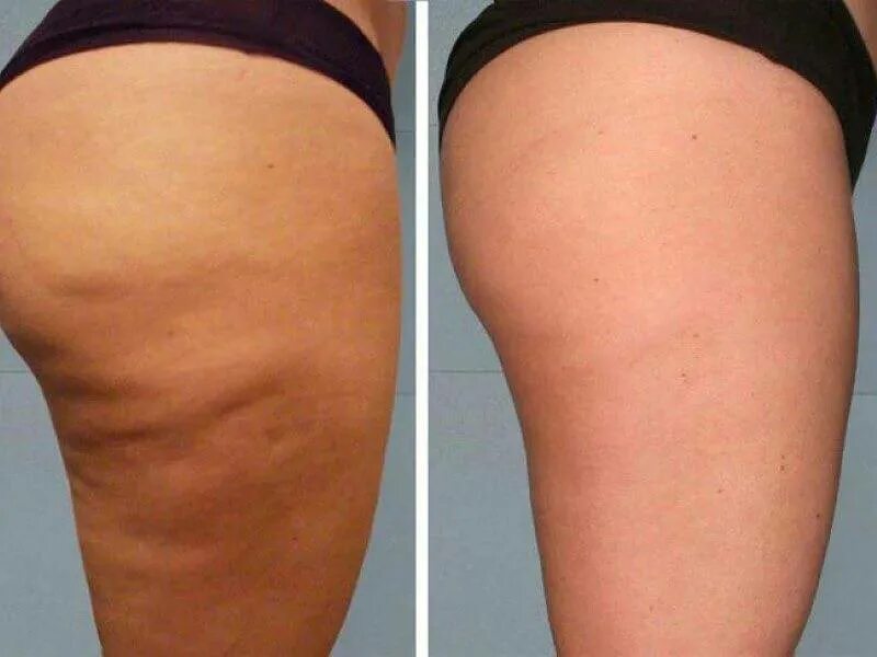 липолитики для лица light fit. Lite fit липолитик. лайт фит липолитик до и после. лайт фит премиум липолитик. липолитик лайт отзывы.