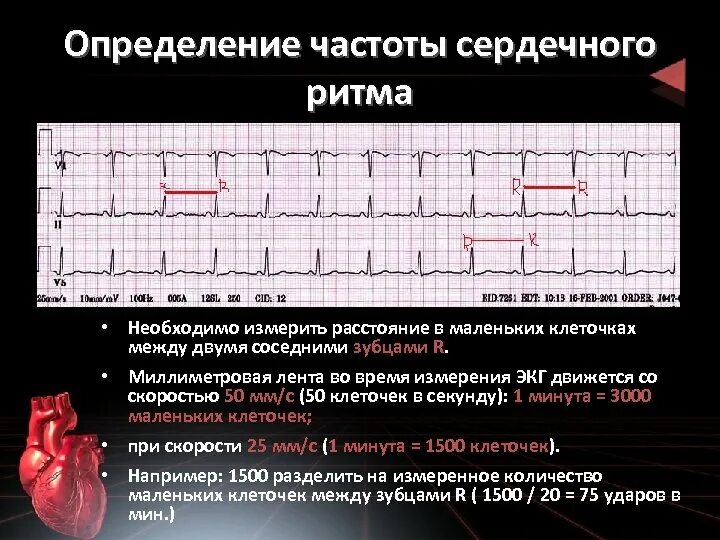 Формула ЧСС по ЭКГ 25 мм. Частота сердечных сокращений на ЭКГ 50мм. Подсчет ЧСС на ЭКГ 50 мм/с. Подсчет ЧСС на ЭКГ 25 мм/с. Усиливают частоту сердечных сокращений