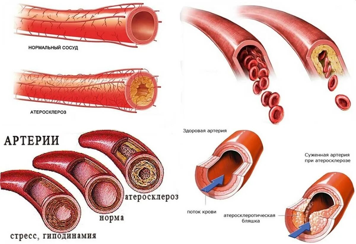 Атеросклероз стенки артерии. Атеросклеротическая болезнь сосудов. Атеросклеротическое поражение кровеносных сосудов. Атеросклероз поражает артерии. Почему сужаются сосуды