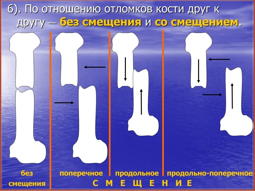 Основные типы смещения костных отломков. Угловое смещение костных отломков. Со смещением костных отломков. Виды смещения костных отломков при переломе. Классификация смещений костных отломков.