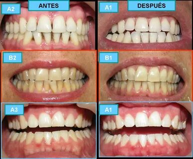 Antes de