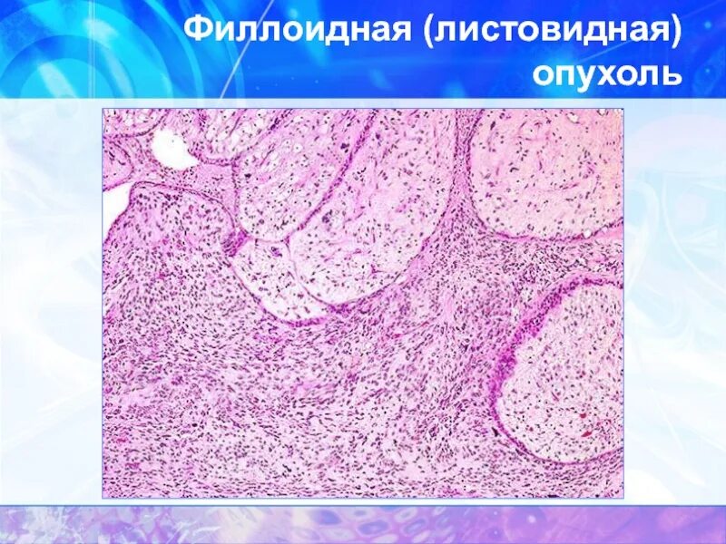 Фиброаденома гистология. Филлоидная фиброаденома гистология. листовидная фиброаденома гистология. филлоидная (листовидная) опухоль. филлоидная фиброаденома молочной железы.