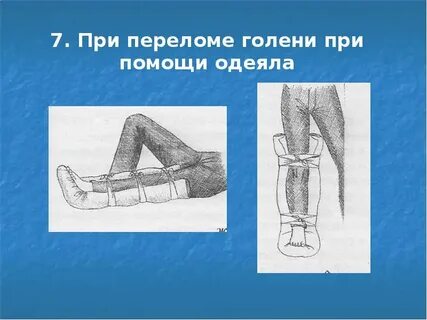 Перелом голени помощь