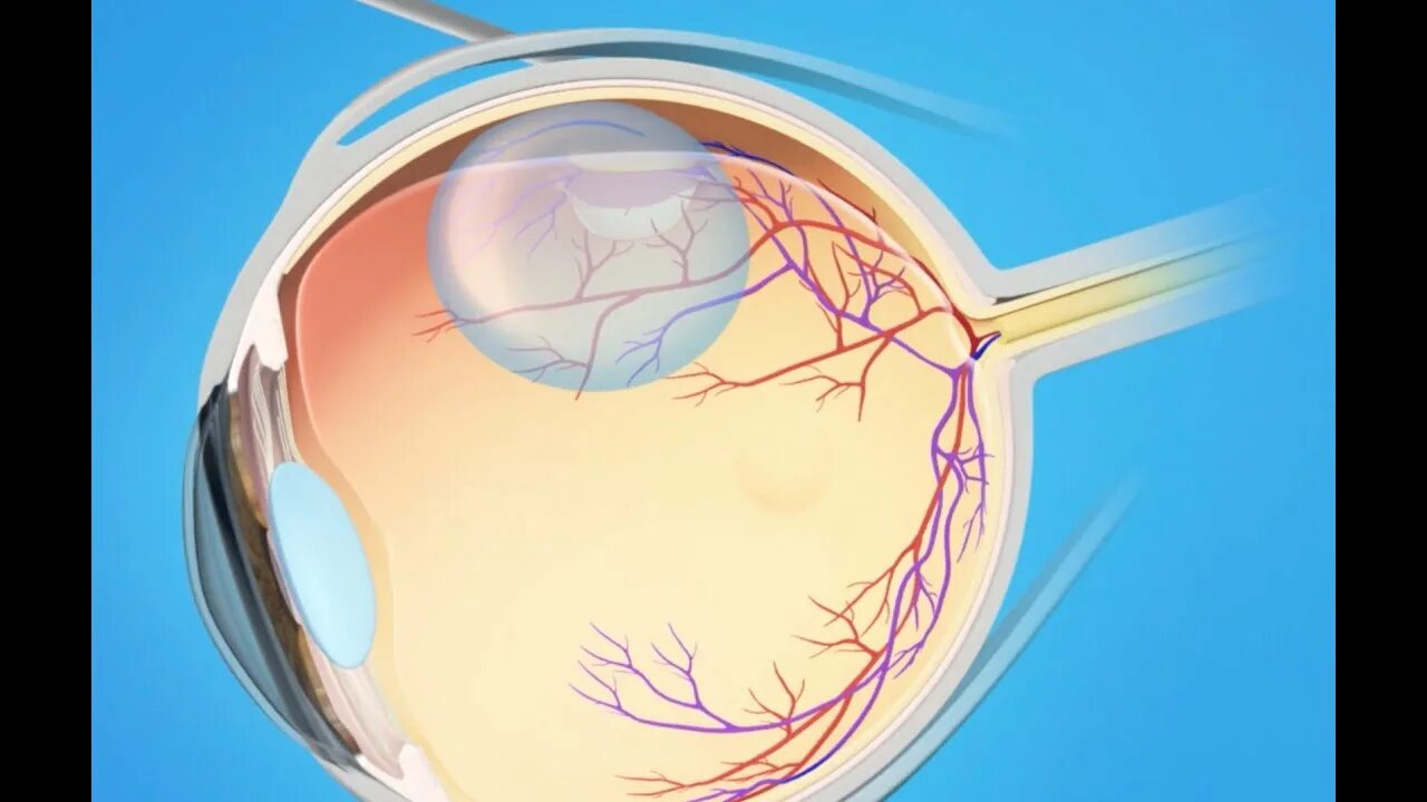 Криокоагуляция сетчатки. Транссклеральной криопексии. Криопексия сетчатки глаза.