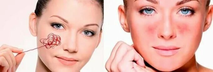 Фотоудаление сосудистой сеточки и фотоудаление сосудов