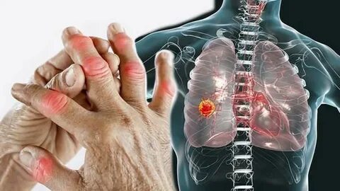 Cancer risk