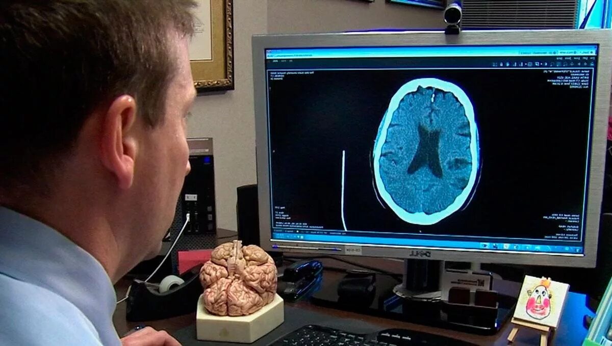 Лечение мозга после инсульта. Инсульт снимок. Снимок мозга после инсульта. Кт головного мозга после инсульта.