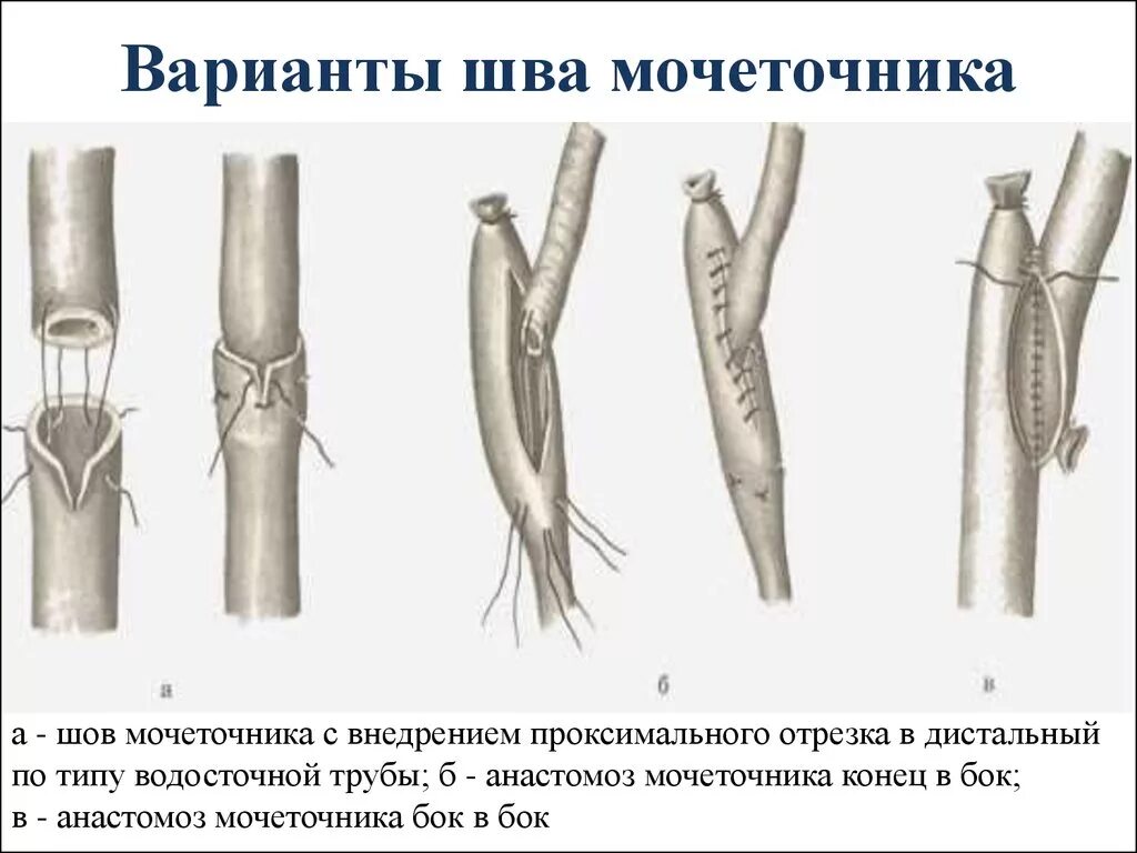 Травма мочеточника. Шов мочеточника топографическая анатомия. Шов почки топографическая анатомия. Первичный шов мочеточника.