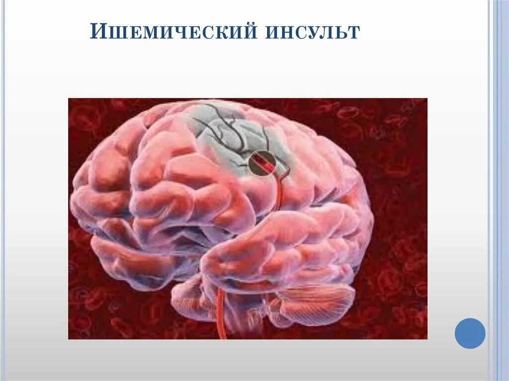 Острые нарушения кровообращения цнс. ОНМК ишемический инсульт. Ишемический инсульт поражения артерий. Ишемическом мозговом инсульте.