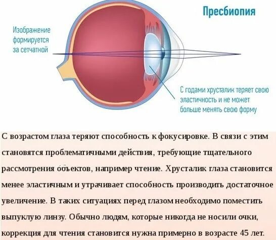 Почему у людей пожилого возраста развивается дальнозоркость. Пресбиопия этиология. Пресбиопия (возрастная дальнозоркость). Старческая дальнозоркость (что это такое? Методы коррекции). Механизм аккомодации пресбиопия.