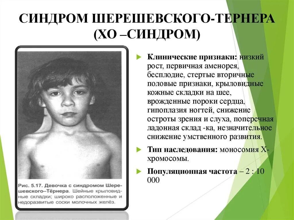 Шерешевский Тернер синдром симптомы. Наследственные заболевания Шерешевского Тернера. Синдром Шерешевского Тернера возникает вследствие нарушений. Синдром Шерешевского Тернера клинические симптомы. Типа тернер