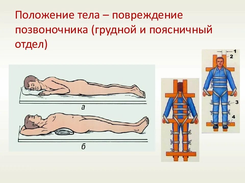 Травма поясничного отдела позвоночника. Транспортировка при переломе позвонка. Положение тела. Иммобилизация при переломе позвоночника.