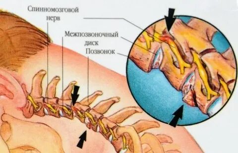 Защемило левую сторону