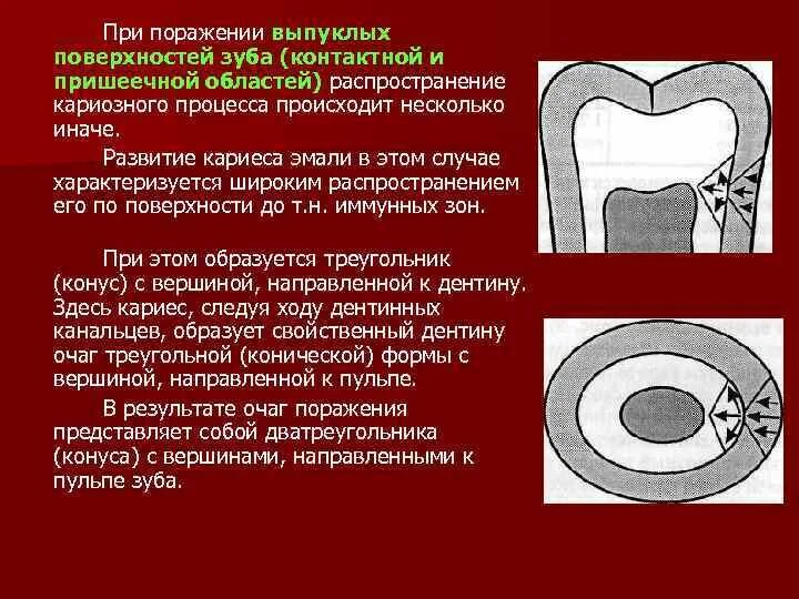 Иммунные зоны. Иммунные зоны зуба располагаются. Распространение кариозного процесса. Распространение кариозного процесса в эмали.