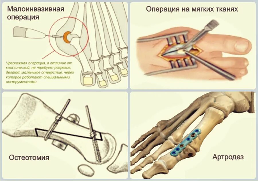 Схема операции халюс вальгус. Операции при халлюкс вальгус. Степень деформации халюкс вальгус. Остеотомия при вальгусной деформации. Вальгусная операция отзывы