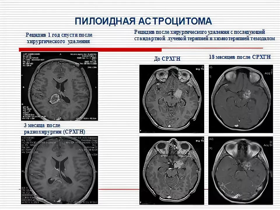 Пилоидная астроцитома. Фибриллярная астроцитома патанатомия. Пилоцитарная астроцитома ствола. Пилоидная астроцитома мрт. Астроцитома мозжечка кт.