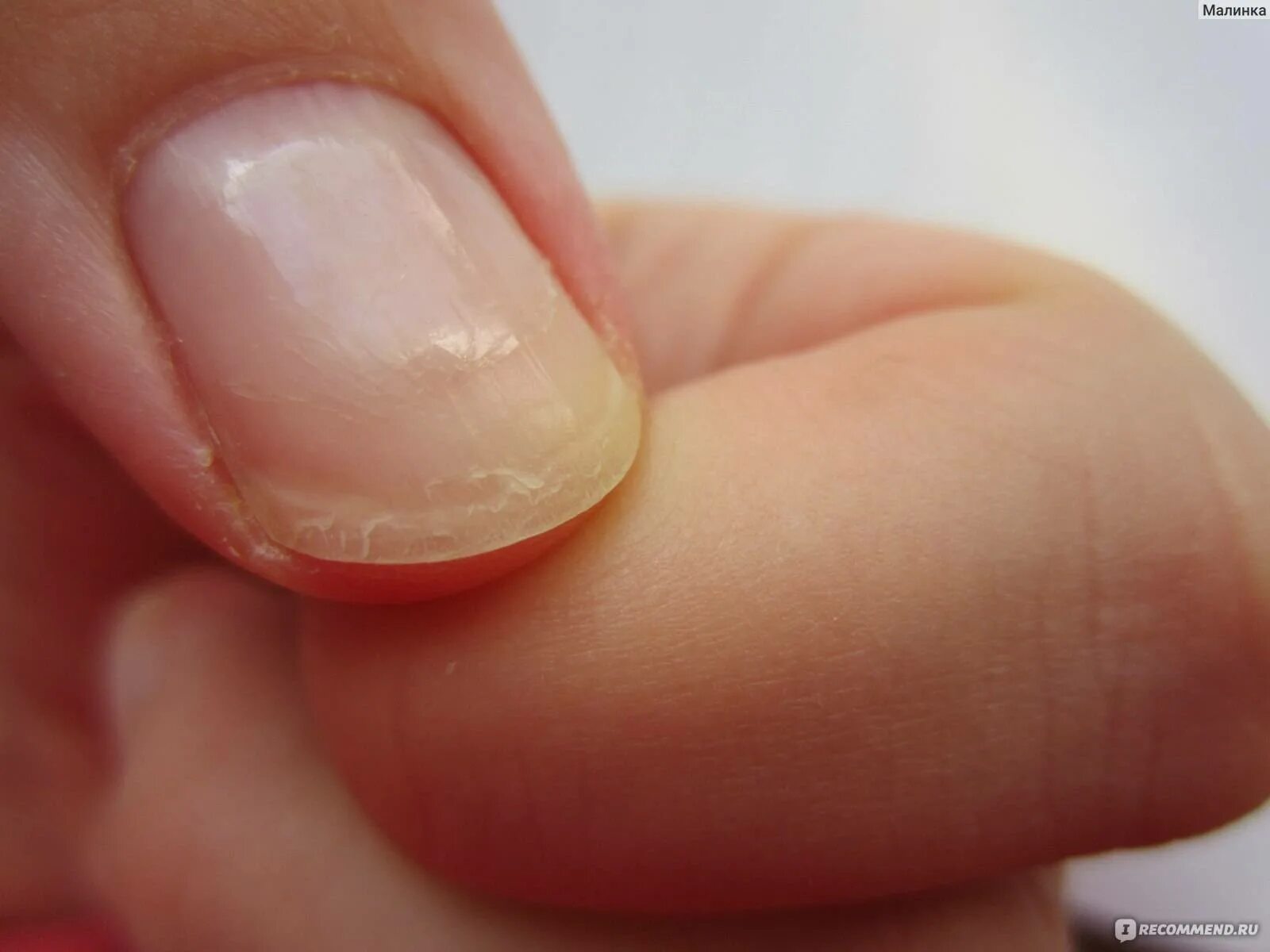 Ногти тонкие мягкие что делать. Онихошизис ногтевой пластины.