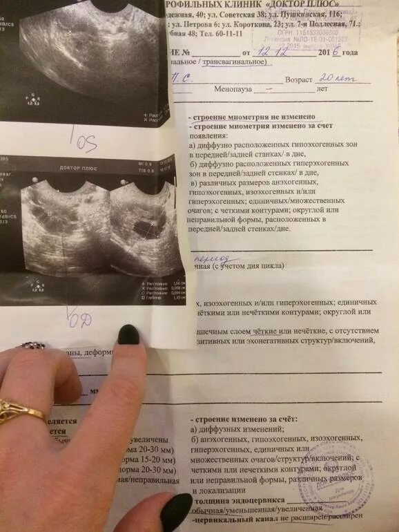 Когда можно идти на узи. Матка после овуляции узи. желтое тело по дням узи. узи на 28 день цикла.