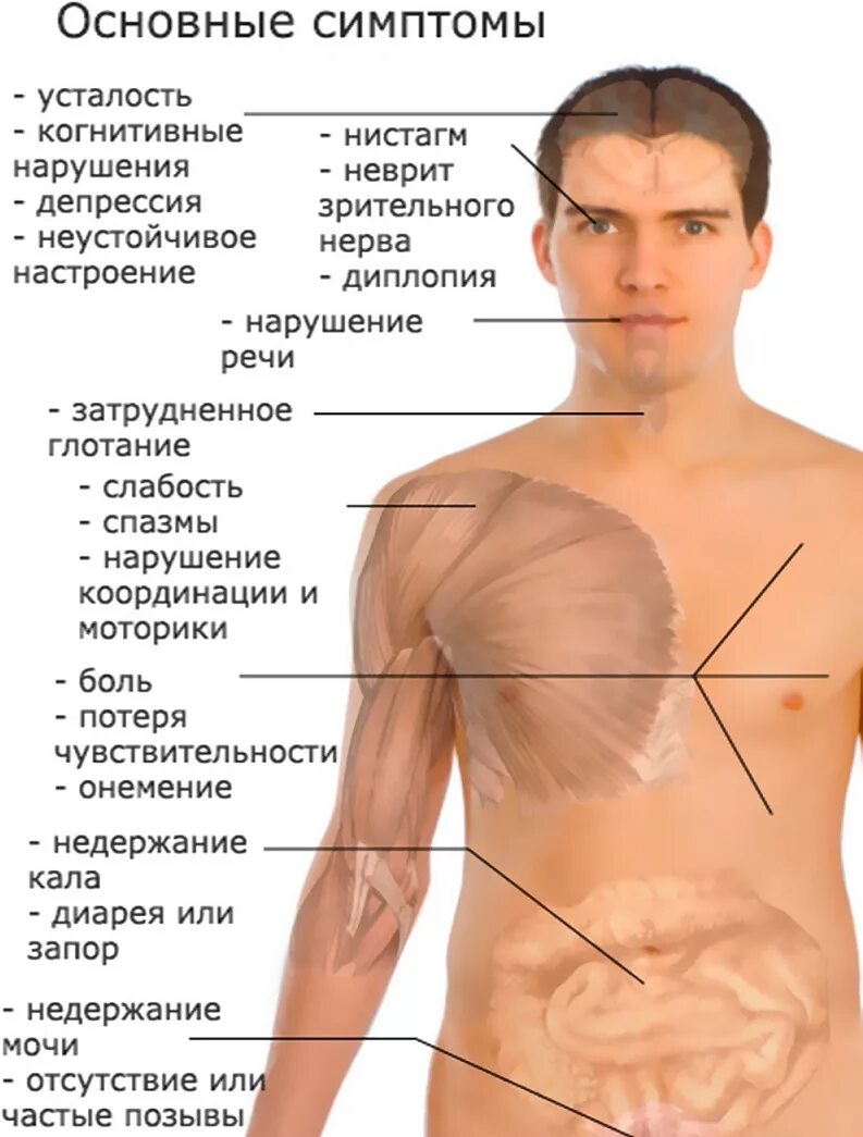 Симптомы рс. Рассеянный склероз. рассеянный склероз симптомы. рассеянный склероз симпто. расеянныймсклероз симптомы.