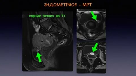 Эндометриоз мрт