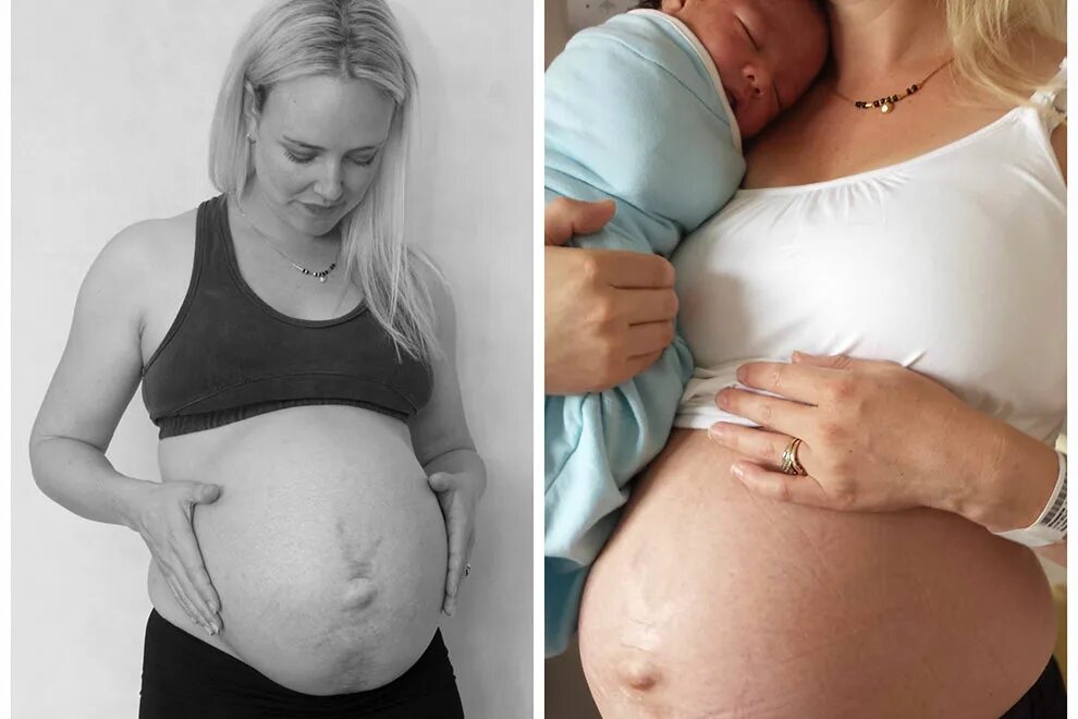 Беременность через полгода после родов. 37 недель можно рожать