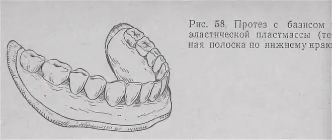 Толщина базиса. Моделировка базиса верхней челюсти. Протезы с двухслойным базисом. Границы базиса протеза на верхней челюсти. Двухслойный Базис съемного протеза.