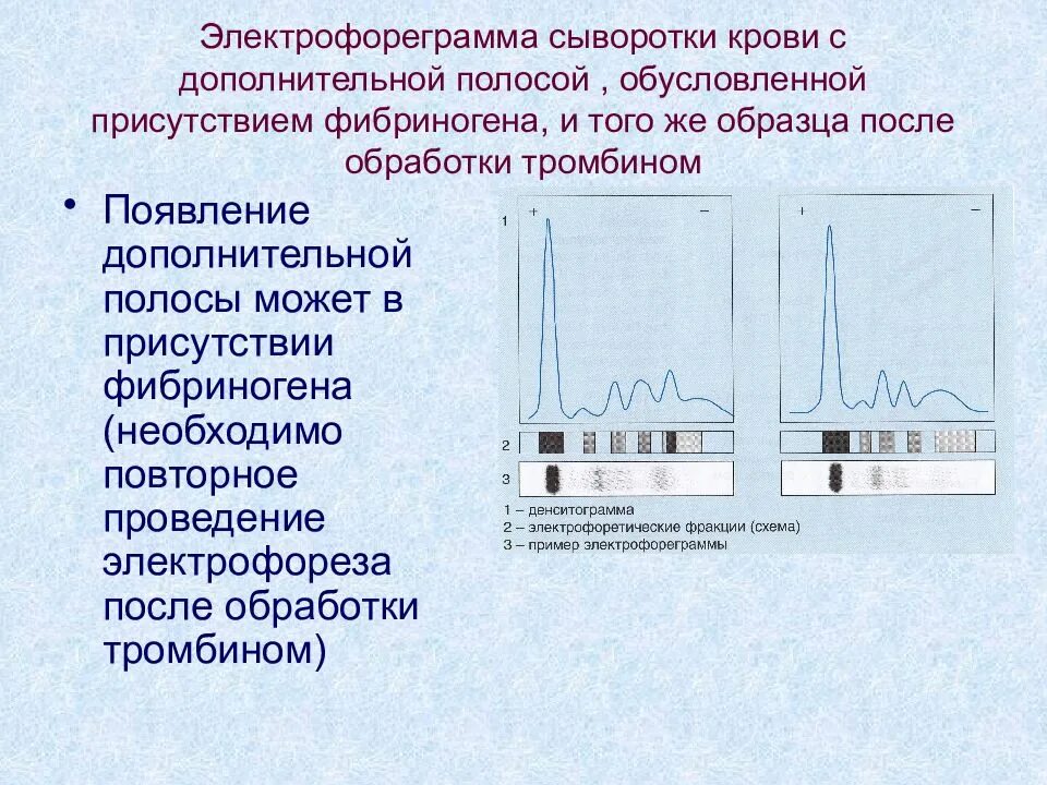 Тест песня электрофорез. Электрофорез белков сыворотки норма. Электрофорез белков сыворотки крови норма. Электрофореза белковых фракций сыворотки крови алгоритм. М градиент при электрофорезе белков сыворотки крови.