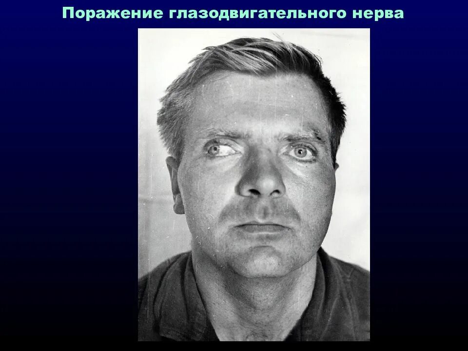 Парез отводящего. Поражение глазодвигательного нерва. неврит глазодвигательного нерва. симптомы поражения глазодвигательного нерва. парез глазодвигательных нервов.