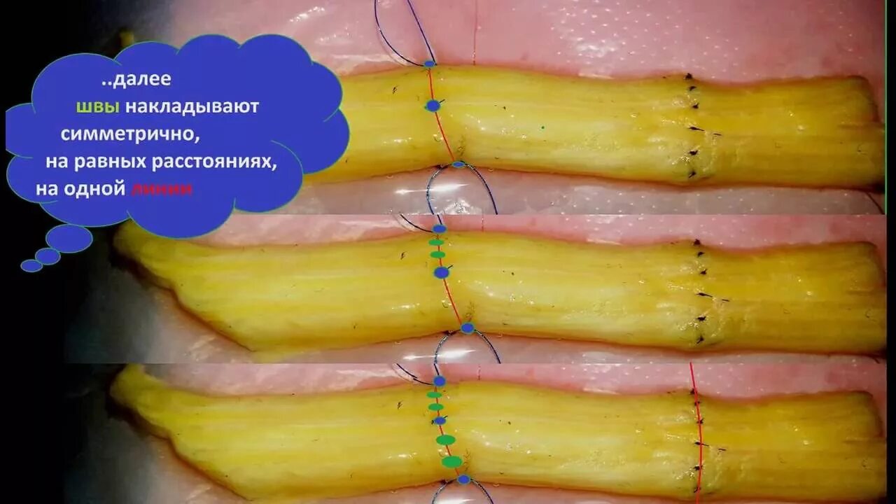 Сшивание нерва латынь. Эпиневральный шов нерва. Периневральный шов шов.