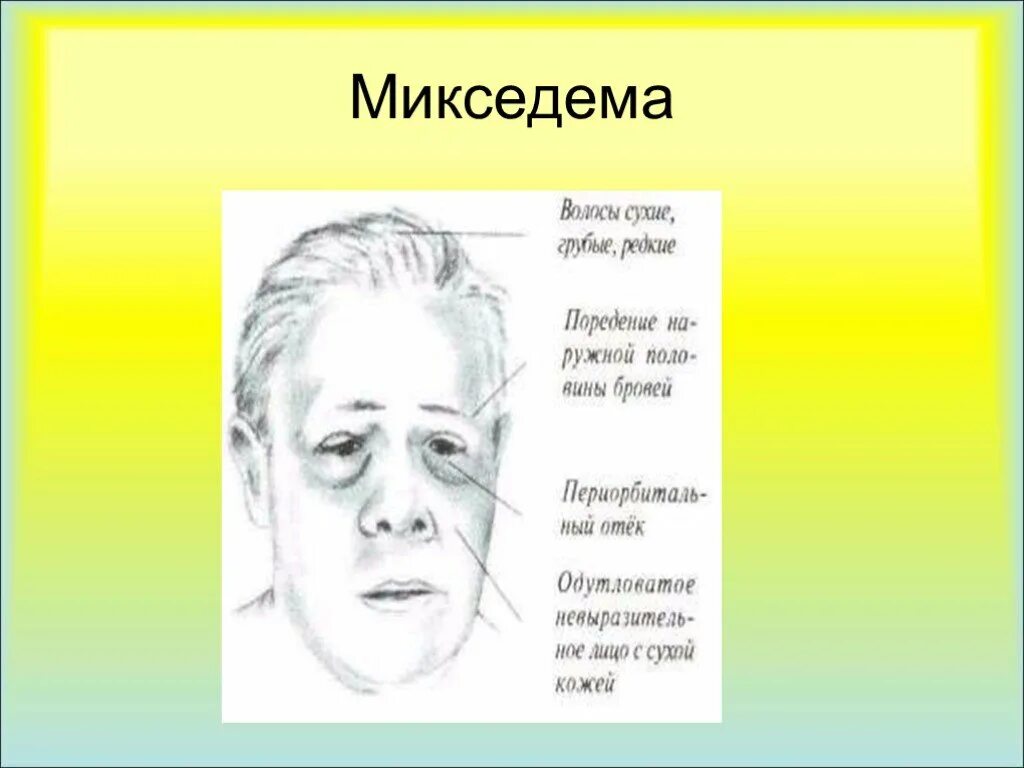 Мексидема. Микседема симптоматика. Клинические проявления микседемы. Внешние проявления микседемы. Микседема слизистый отек.