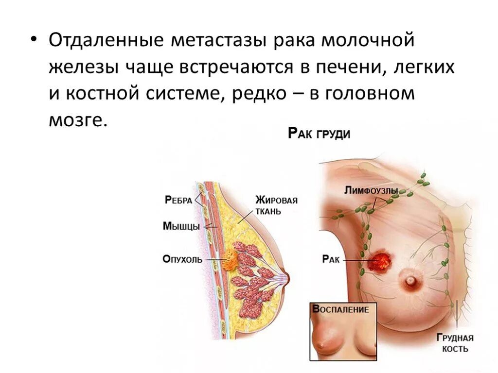 Печень и молочные железы. Опухоль молочной железы. Метастазы м молочной железы. Злокачественное новообразование молочной железы. Локализация опухоли молочной железы.