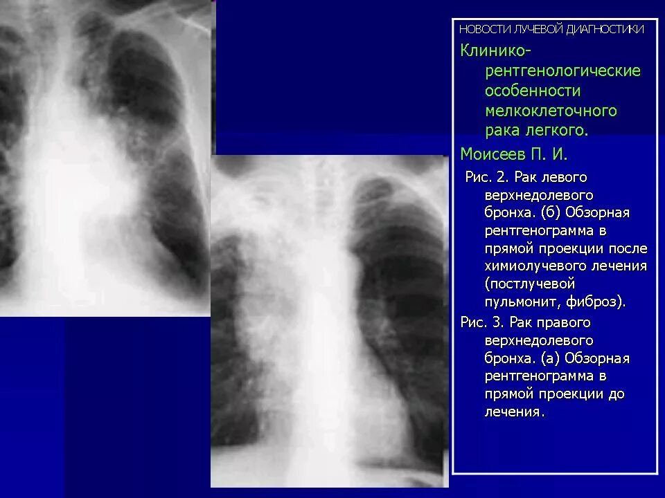 Лимфома в легких на рентгенограмме. Рентгенодиагностика туберкуломы.
