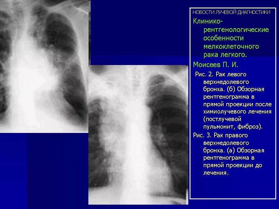 Легкие фиброзного характера. Лимфома в легких на рентгенограмме. Рентгенодиагностика туберкуломы.