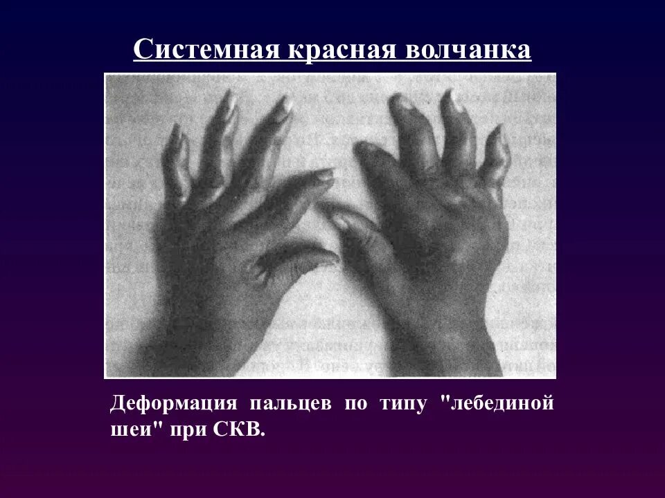Как выглядит системная красная волчанка Системная красная волчанка! (СКВ) презентация, доклад, проект скачать