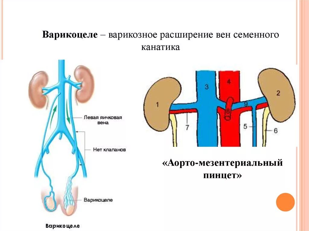 Расширение семенной вены. Аорто мезентериальный пинцет левой почечной вены. Варикоцеле мезентериальный пинцет. Синдром аорто-мезентериального пинцета. Варикозное расширение вен семенного канатика яичка..