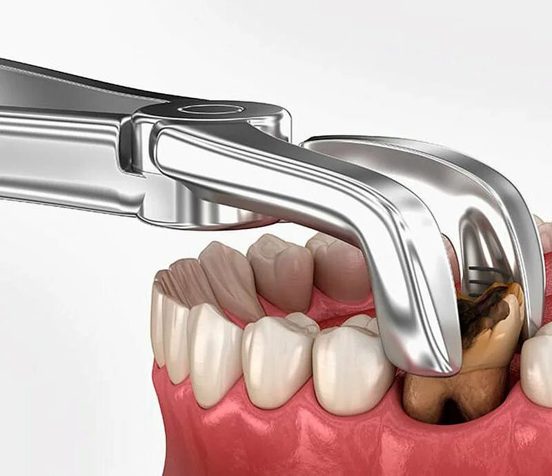 Стоматология мудрый. Хирургия (удаление зубов, зубосохраняющие операции). Имплантаты прицельный снимок.