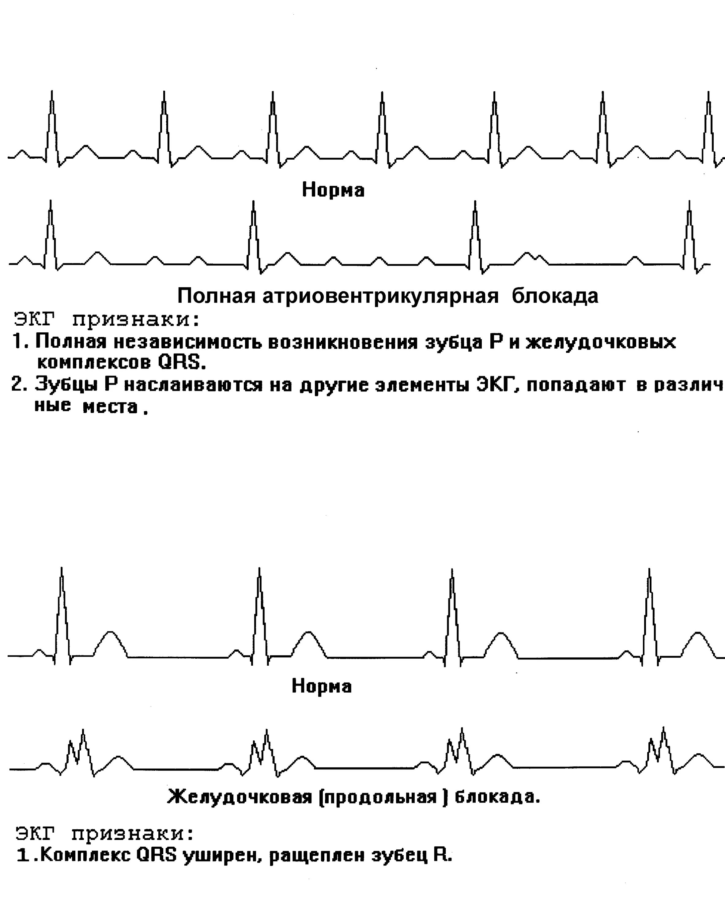 Полная АВ блокада на ЭКГ признаки. Блокада сердца 2 степени ЭКГ. ЭКГ признаки полной атриовентрикулярной блокады. Блокады сердца на ЭКГ классификация.